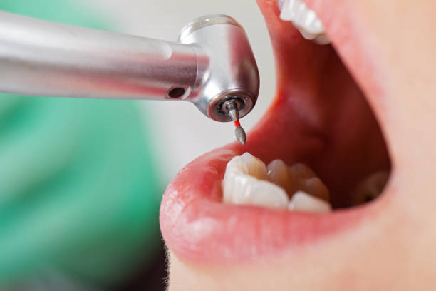 Best Broken or Chipped Tooth Repair in Evergreen, MT
